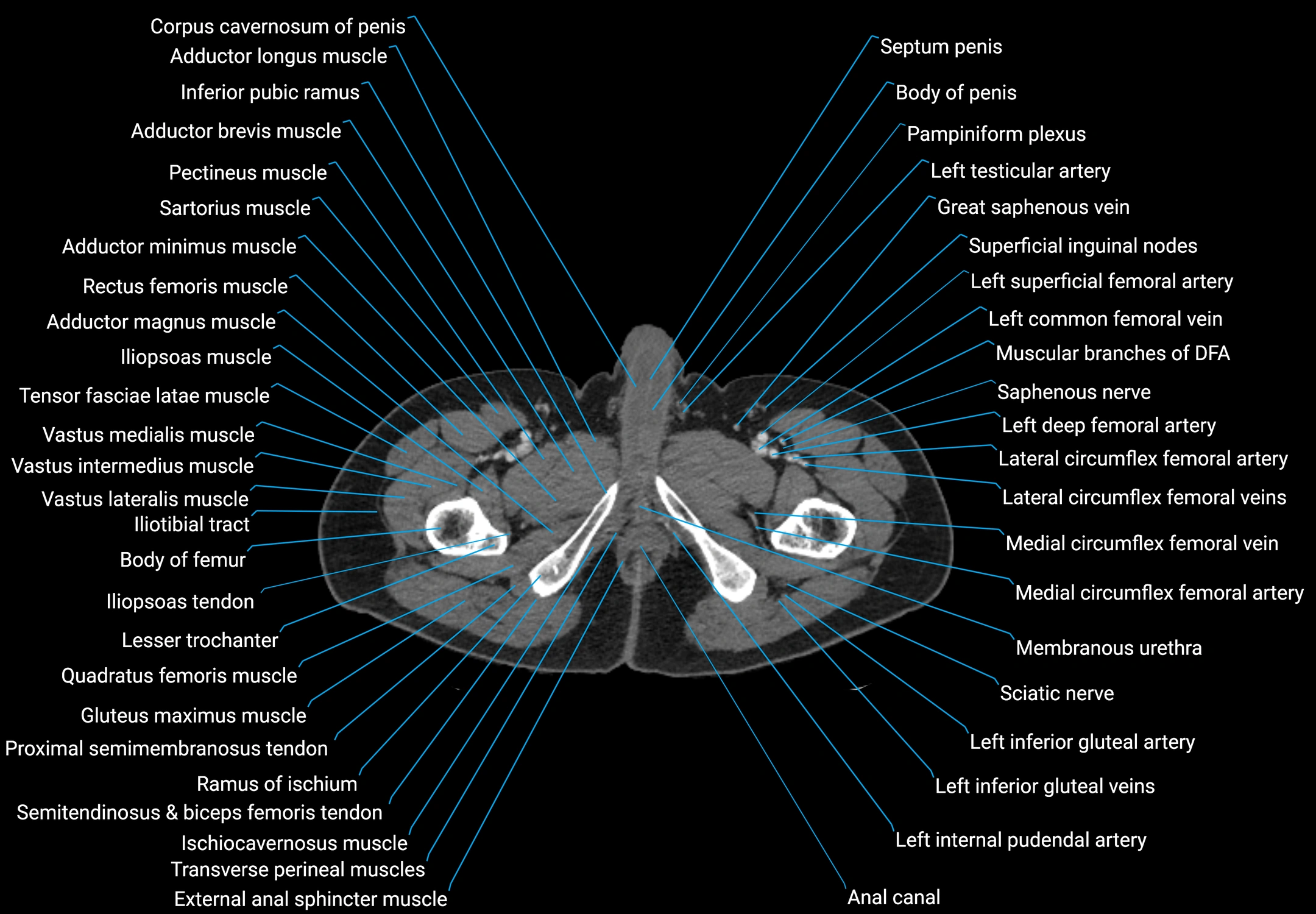 CT male pelvis axial cross sectional anatomy labelled radiology image -00213.webp